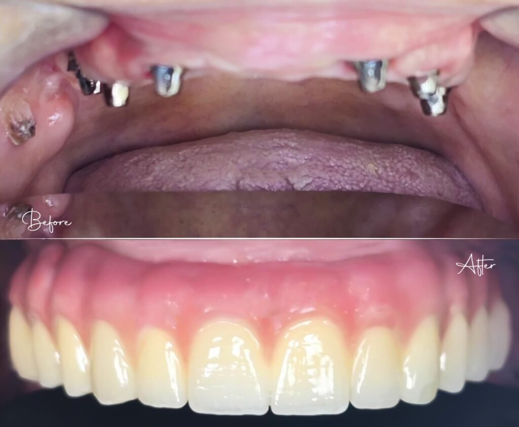 Surgery & Implants at ortho smile clinics in lebanon