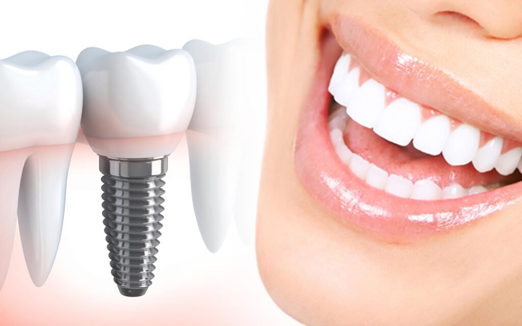 Dental Implants - Magic Smile
