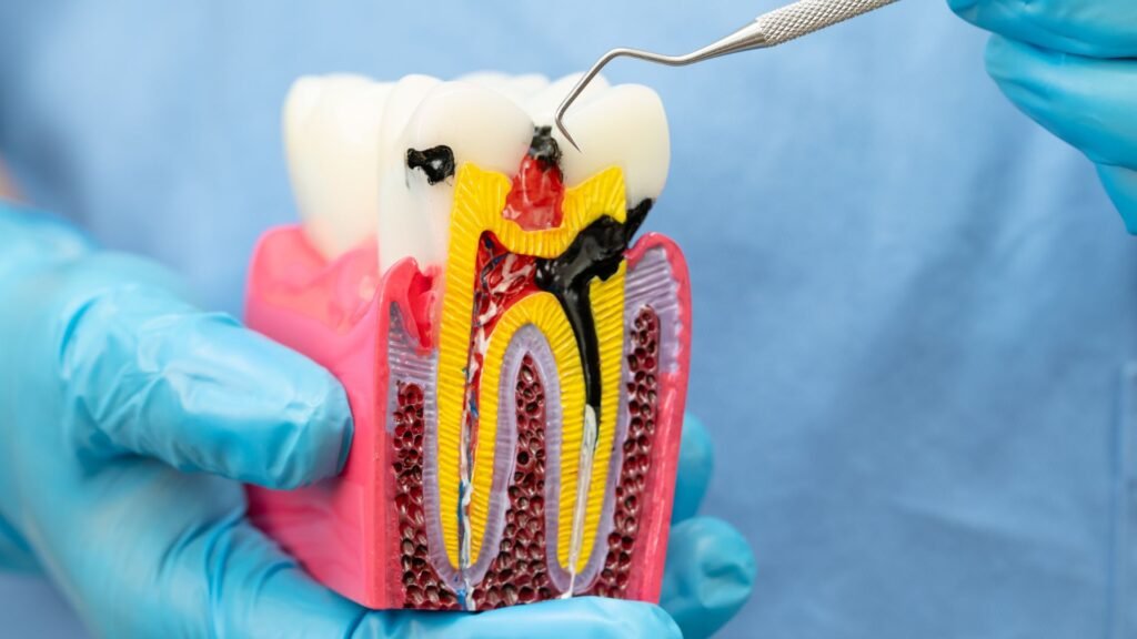 When Do You Need a Root Canal