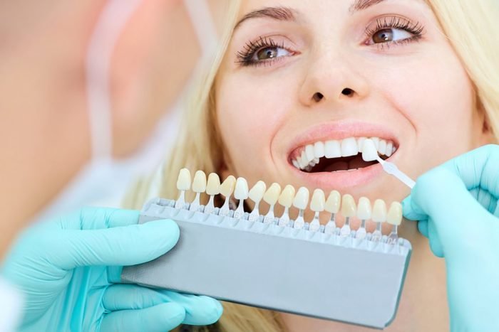 Why Choose Professional Teeth Whitening